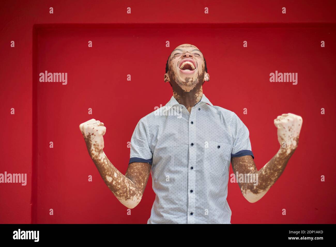 Joven con vitiligo gritando con alegría y riendo en una pared roja Foto de stock