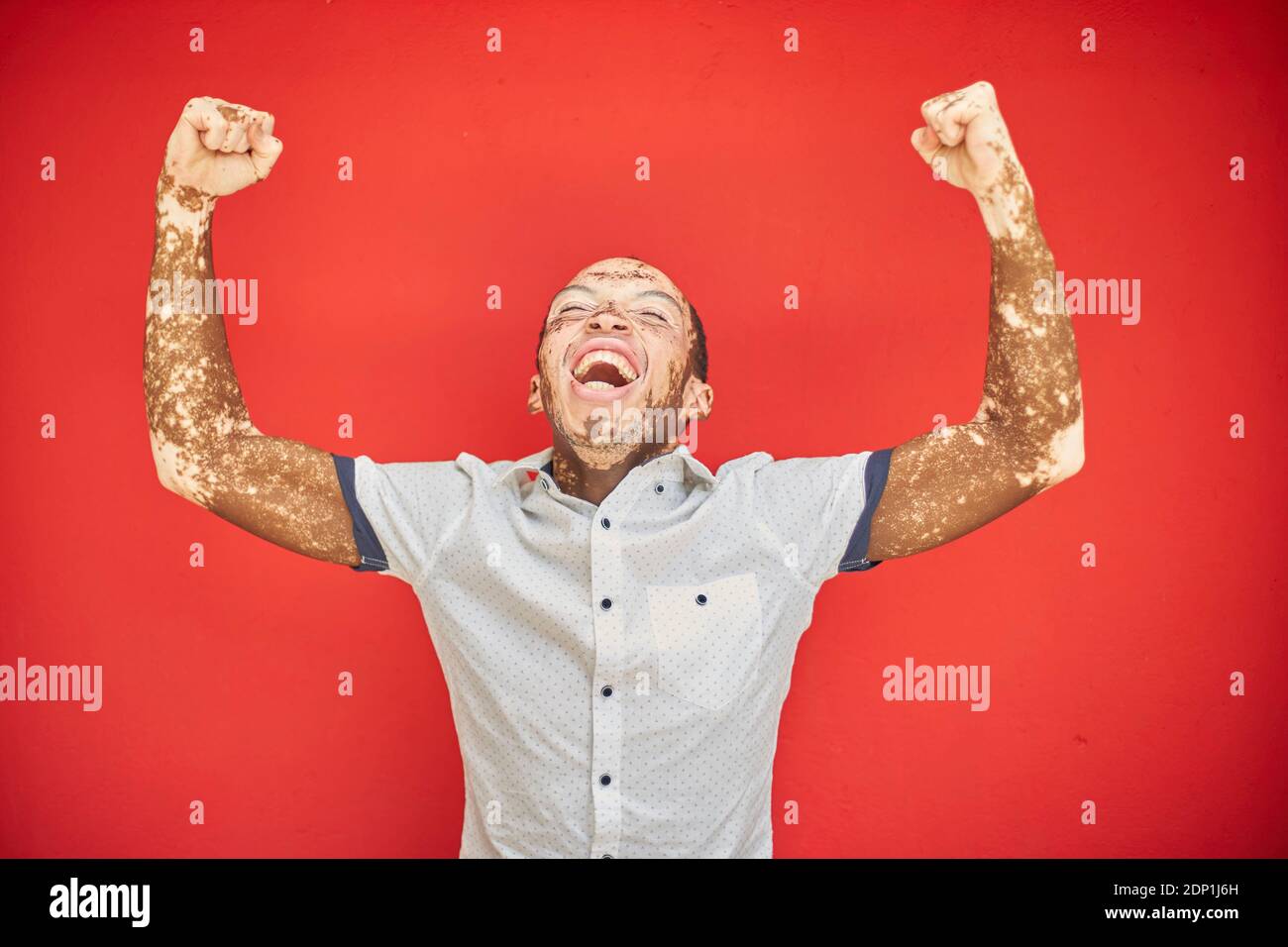 Joven con vitiligo gritando con alegría y riendo en una pared roja Foto de stock