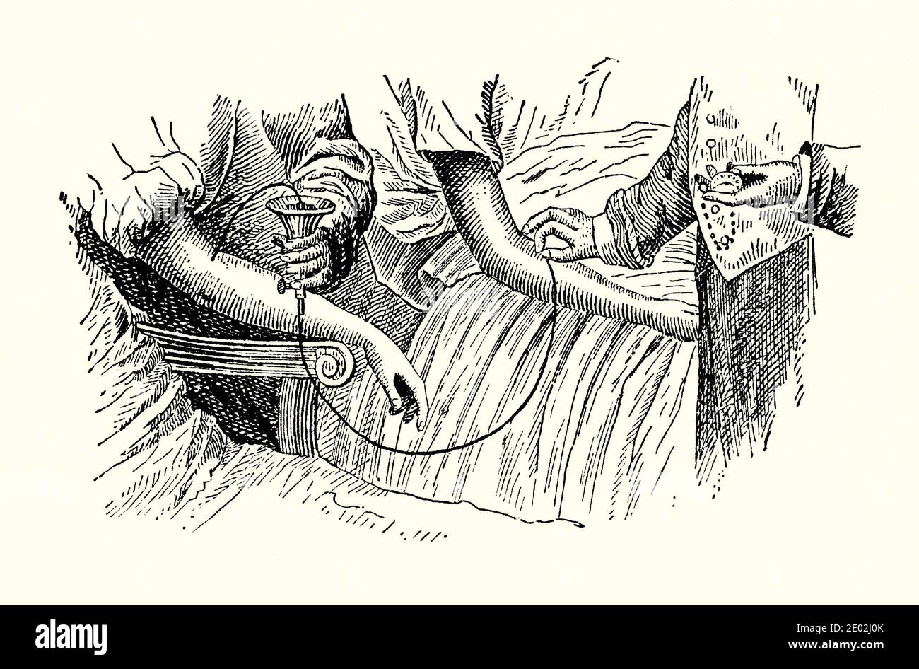 Un viejo grabado de aparatos de transfusión de sangre victorianos. Es de un libro de ingeniería mecánica de la década de 1880. Este dispositivo francés recoge la sangre del donante en una taza (izquierda). La sangre es forzada a través de una cánula en la vena del paciente (derecha). La transfusión de sangre es el proceso de transferir sangre o productos sanguíneos a la circulación de uno por vía intravenosa. Las transfusiones se utilizan para varias afecciones médicas para reemplazar los componentes perdidos de la sangre. Las primeras transfusiones usaron sangre completa, pero hoy en día la práctica médica usa comúnmente solo los componentes de la sangre. Foto de stock