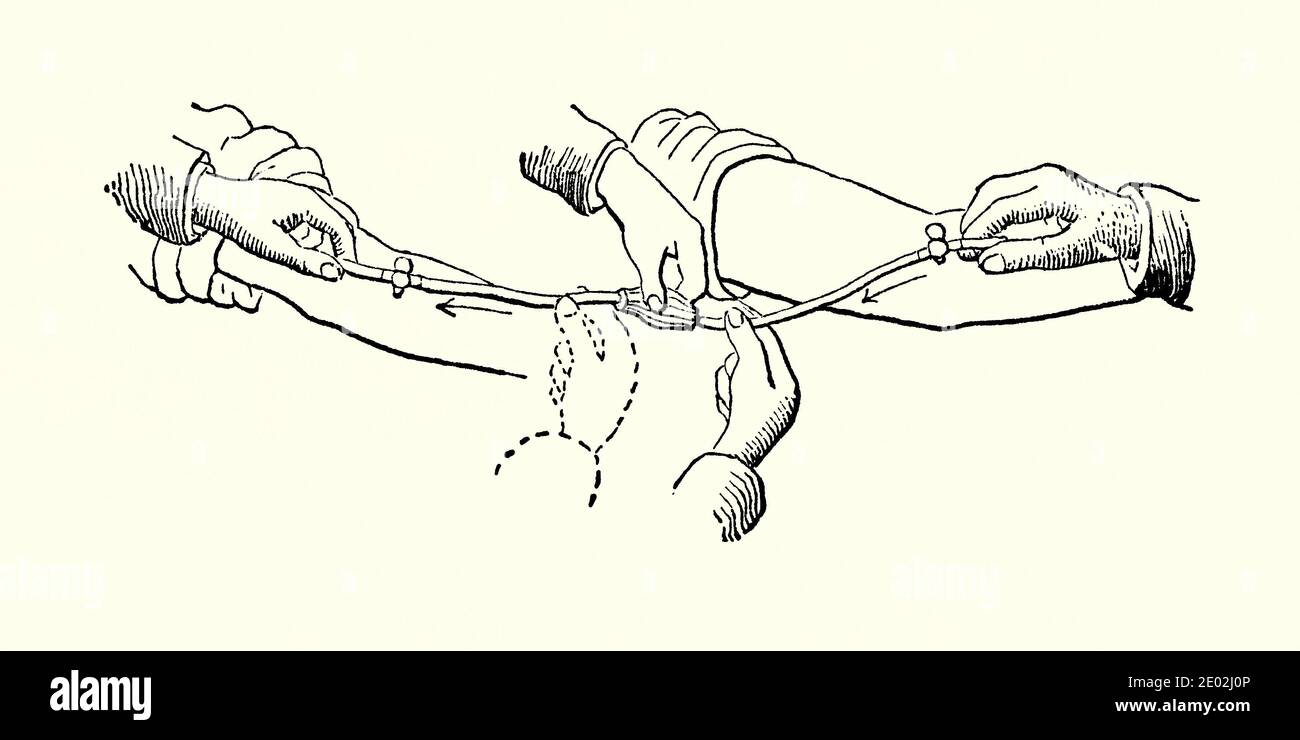 Un viejo grabado de aparatos de transfusión de sangre victorianos. Es de un libro de ingeniería mecánica de la década de 1880. Este dispositivo (aparato de transfusión directa de Aveling) requiere que se inserte un tubo de plata en una vena donante (derecha). La sangre es forzada a entrar en la vena del paciente (izquierda) apretando el bulbo de goma en el centro del aparato. El obstetra británico J H Aveling inventó su sistema en 1872. La transfusión de sangre es el proceso de transferir sangre o productos sanguíneos a la circulación de uno por vía intravenosa. En las primeras transfusiones se utilizó sangre completa. Foto de stock