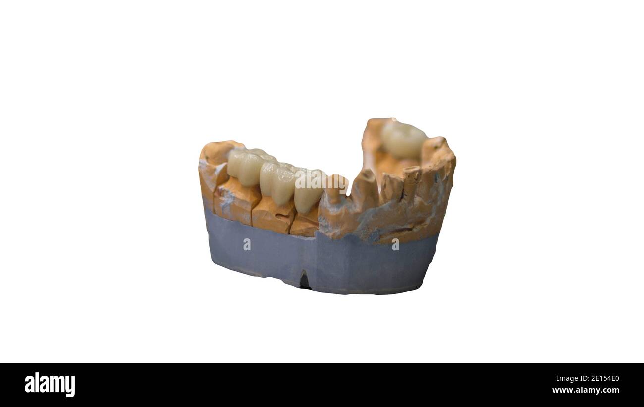 Corona cerámica de un diente basada en un modelo de yeso de dientes, el  trabajo de un técnico dental, herramientas para prótesis dentales. Clínica  para la fabricación Fotografía de stock - Alamy