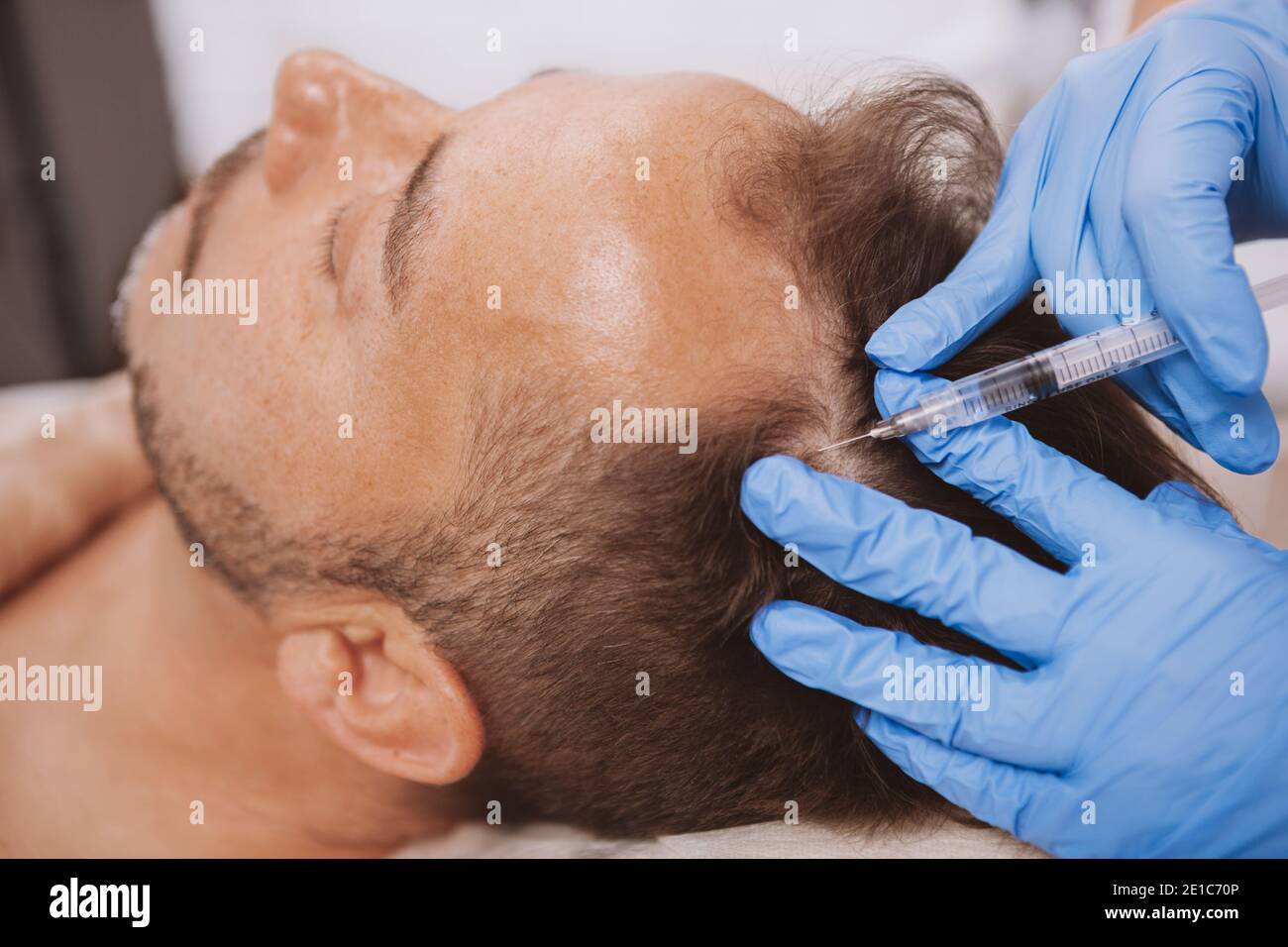 Primer plano de un hombre maduro que recibe inyecciones de tratamiento para  la pérdida del cabello en el cuero cabelludo por un trichólogo profesional.  Dermatólogo haciendo inyecciones para el cuero cabelludo para