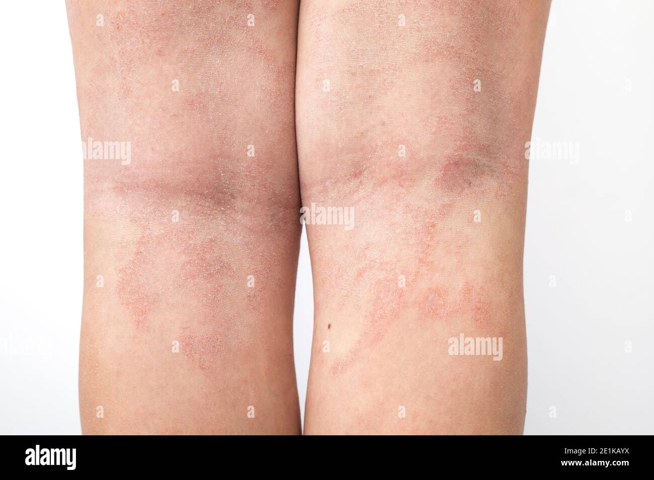 La dermatitis atópica aguda en las piernas detrás de las rodillas de un  niño es una enfermedad dermatológica de la piel. Sarpullido grande, rojo,  inflamado y escamoso en las piernas Fotografía de