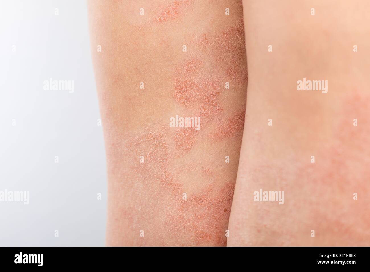 Sarpullido en piernas fotografías e imágenes de alta resolución - Alamy