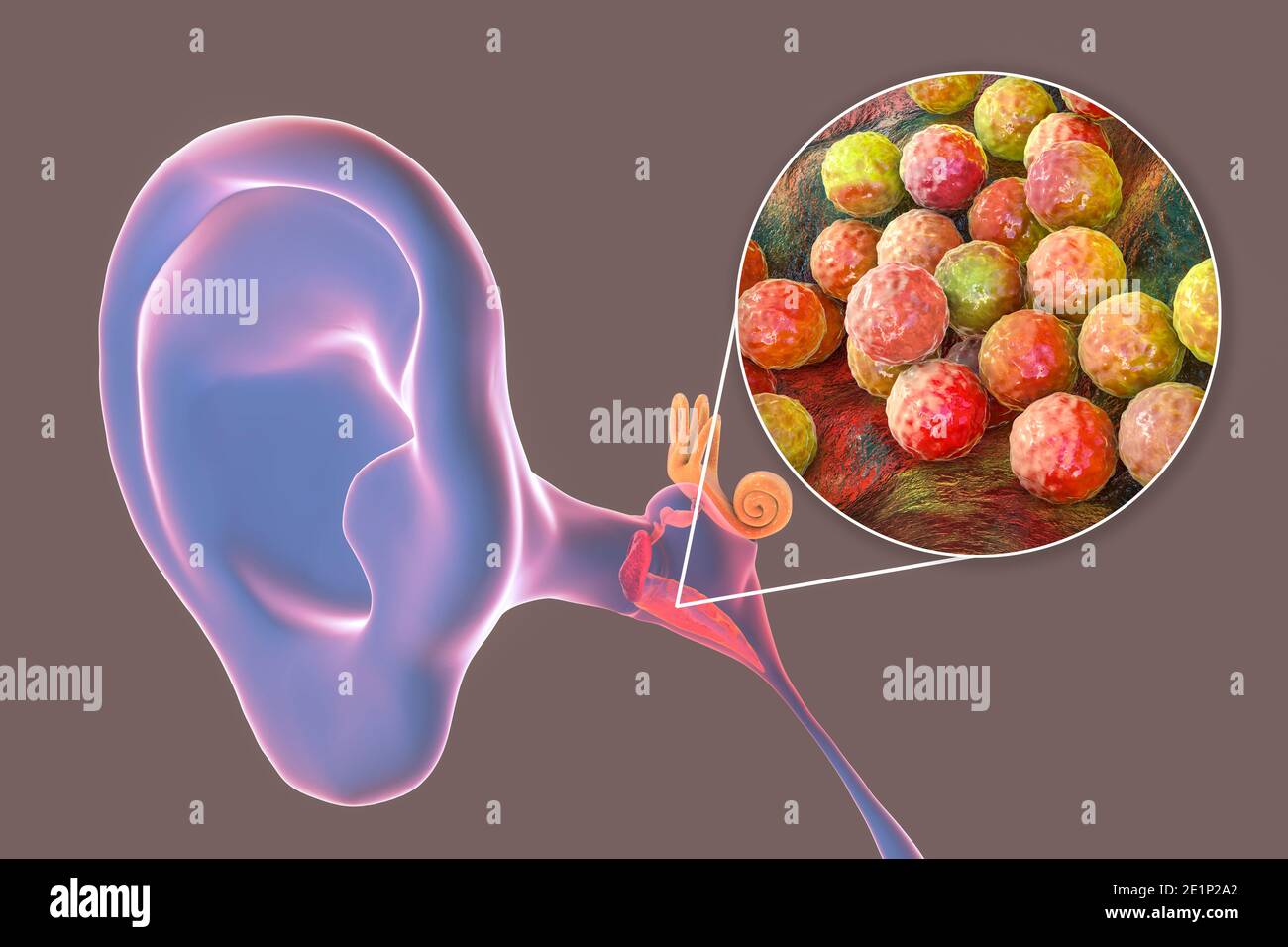 Otitis media infección del oído, ilustración Fotografía de stock Alamy