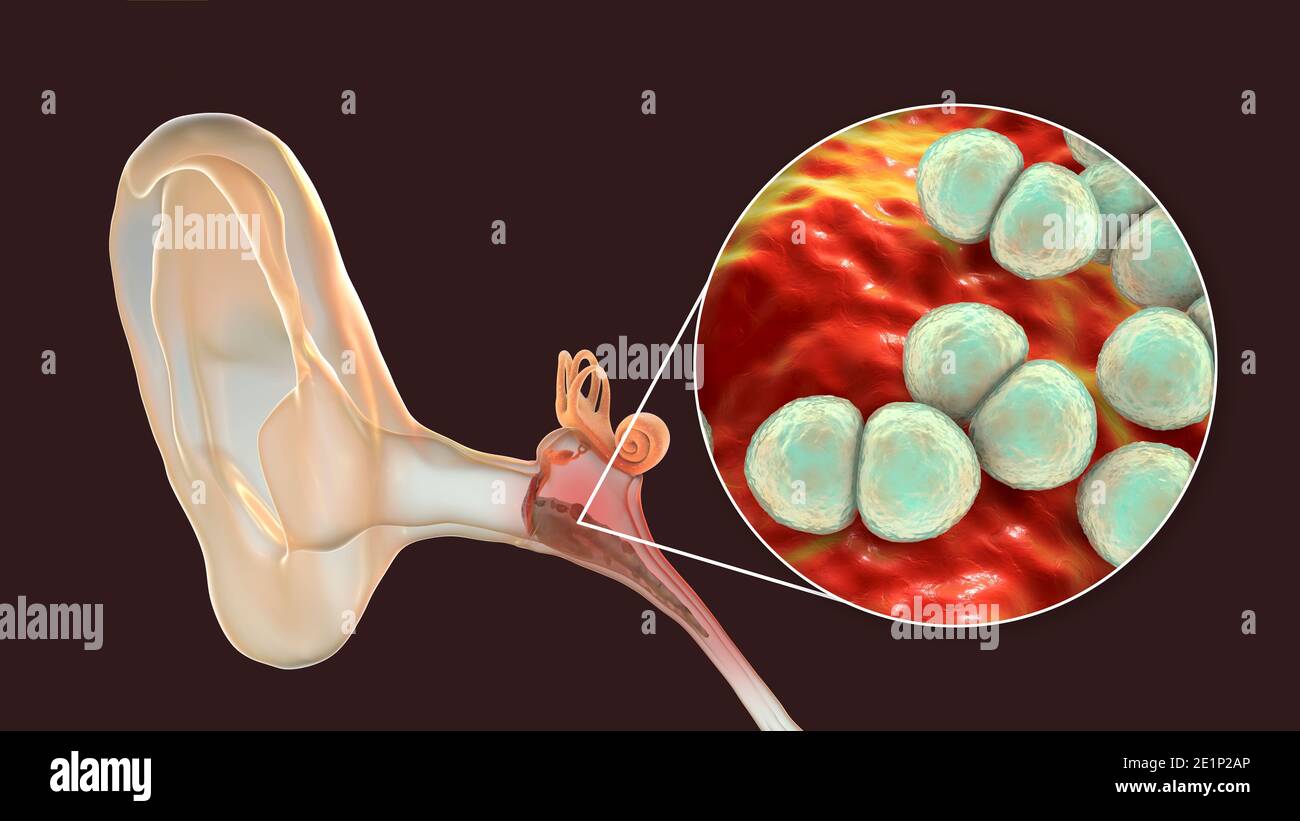 Otitis media infección del oído, ilustración Fotografía de stock Alamy