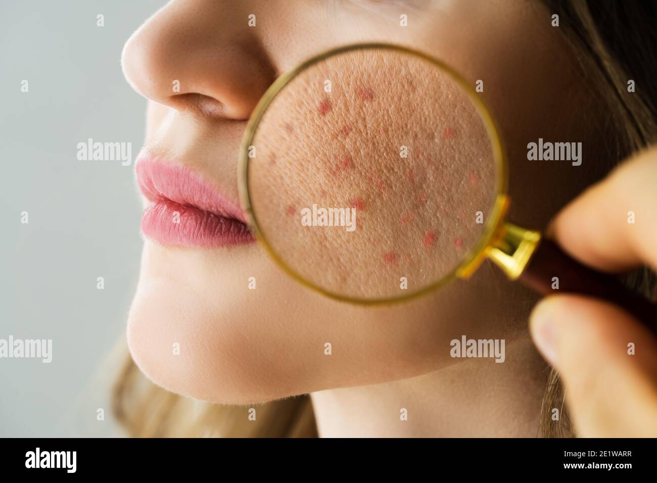 Examen de los problemas de acné en la piel con la lupa Fotografía de stock  - Alamy