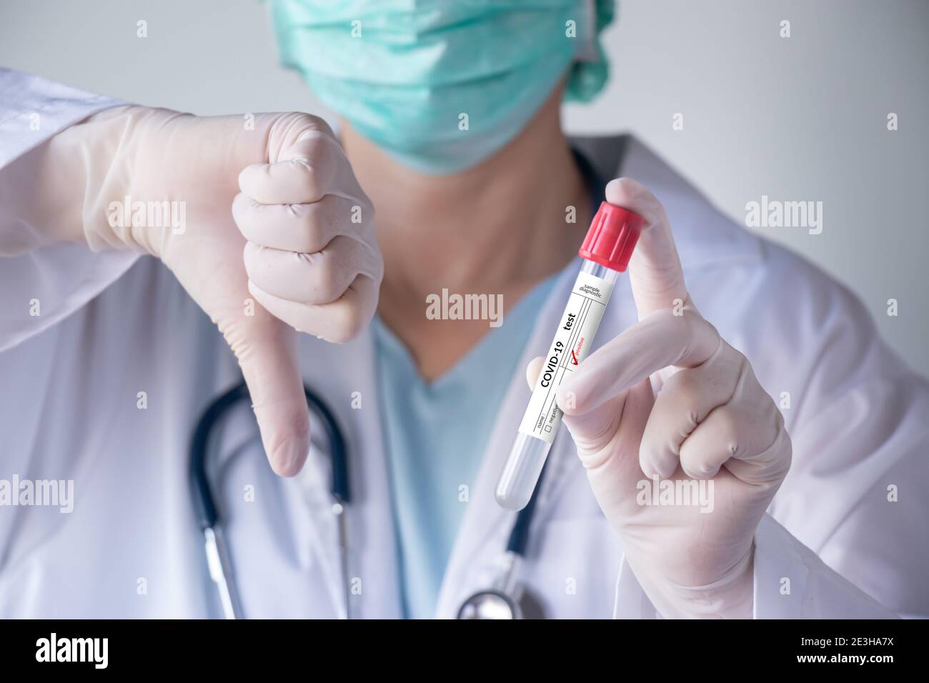Prueba de coronavirus COVID-19. Doctor mano sosteniendo tubo de prueba de infección para la muestra de secreción nasal del paciente, etiqueta de resultado positivo y pulgar abajo gesto Foto de stock