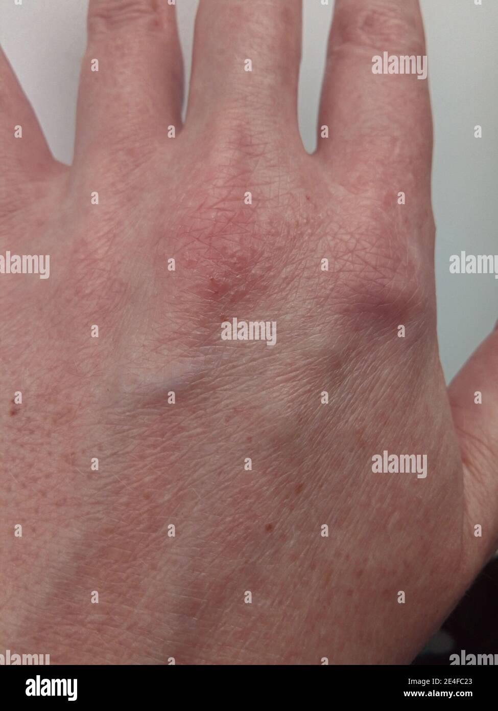 sarpullido y urticaria en la piel del dorso de la mano femenina, reacción  alérgica de la piel, enfermedad del sistema inmunitario del cuerpo  Fotografía de stock - Alamy