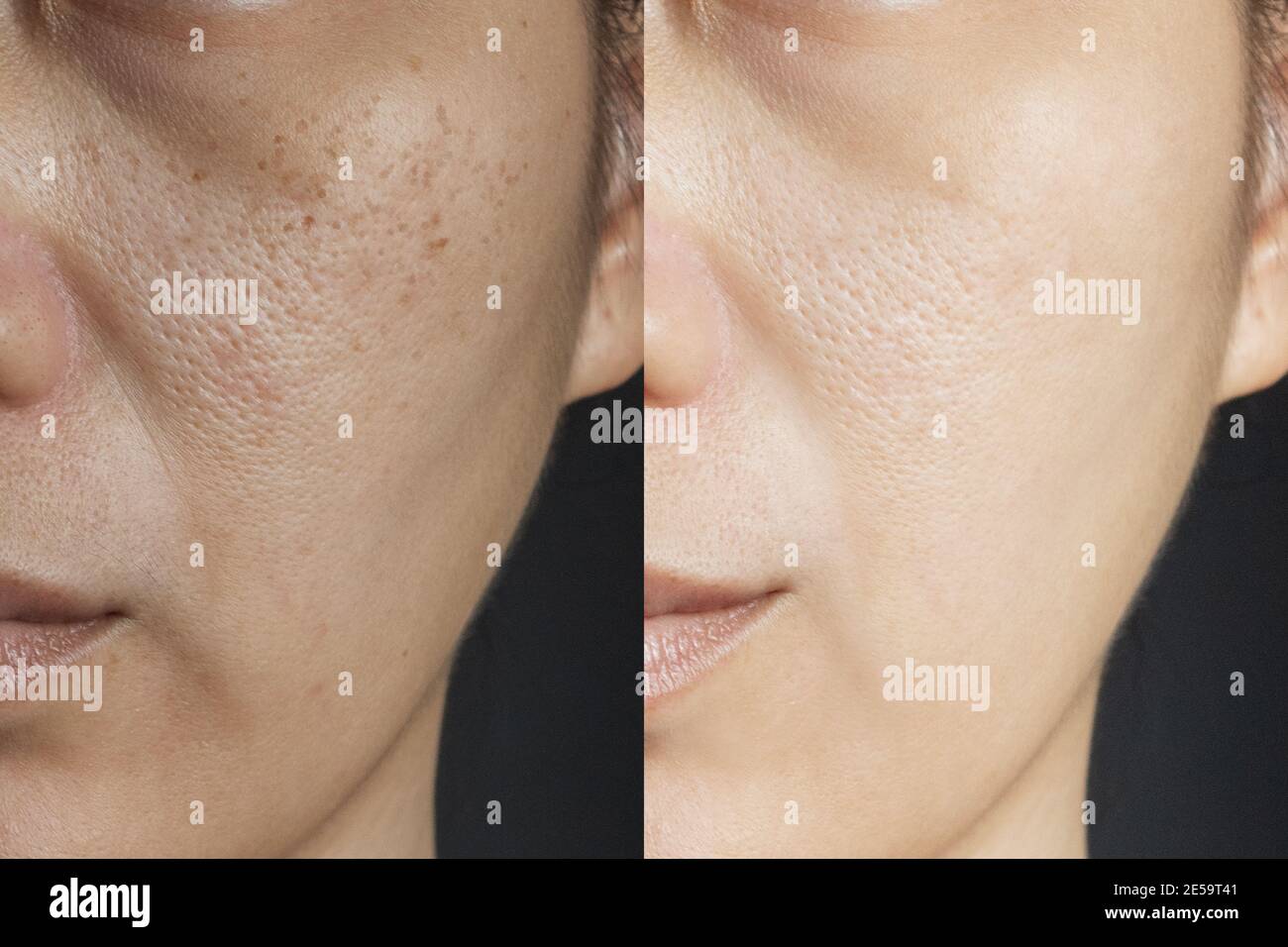 Dos imágenes comparan el efecto antes y después del tratamiento. Piel con problemas de pecas, poros, piel apagada y arrugas antes y después del tratamiento Foto de stock