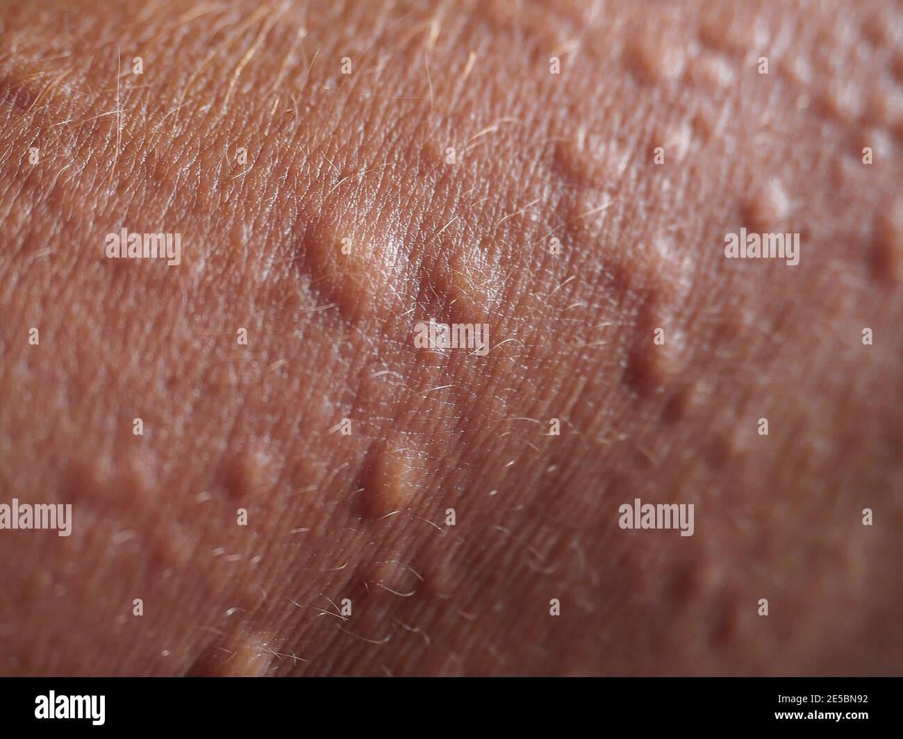 Síntomas de alergia al contacto en la piel. Cerca de la urticaria  Fotografía de stock - Alamy