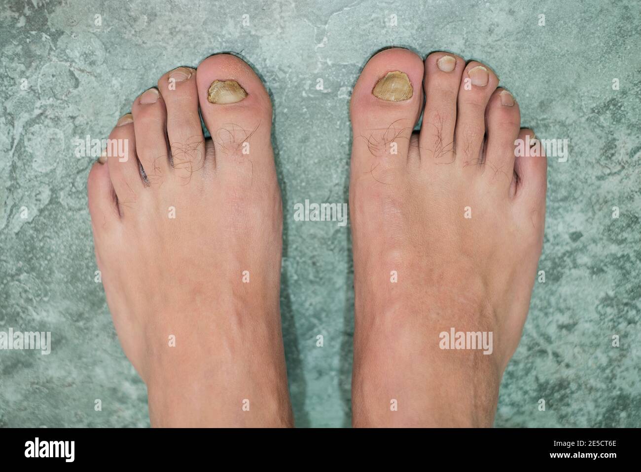 Hombre joven descalzo dedos con uñas enfermas de micosis onycho,dermatologic medical enfermedad, problema de salud Foto de stock