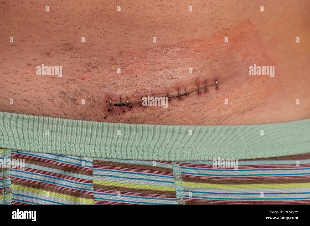 Cicatriz de hernia, cicatriz de hernia inguinal post operatoria Foto de stock