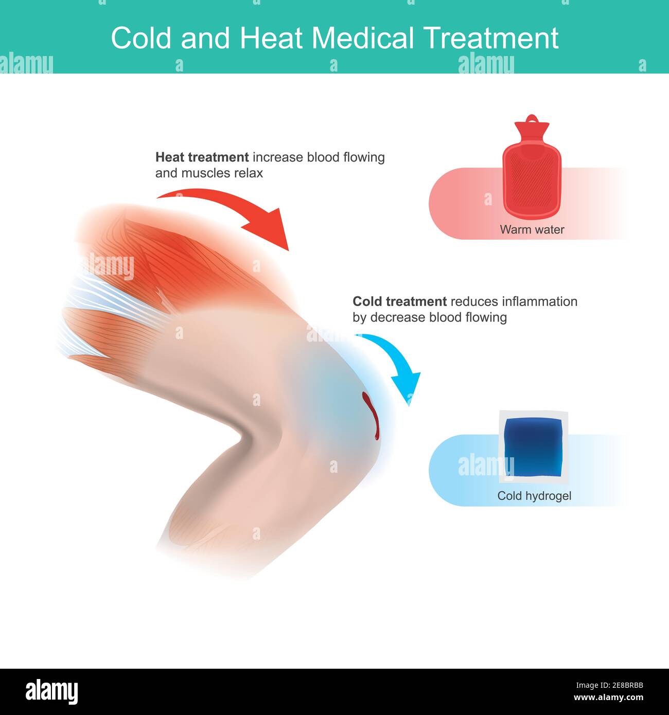 Tratamiento médico para el frío y el calor. Este gráfico explica la pierna humana 2 el dolor y la lesión diferentes incluyen el tratamiento de primeros auxilios. Ilustración del Vector