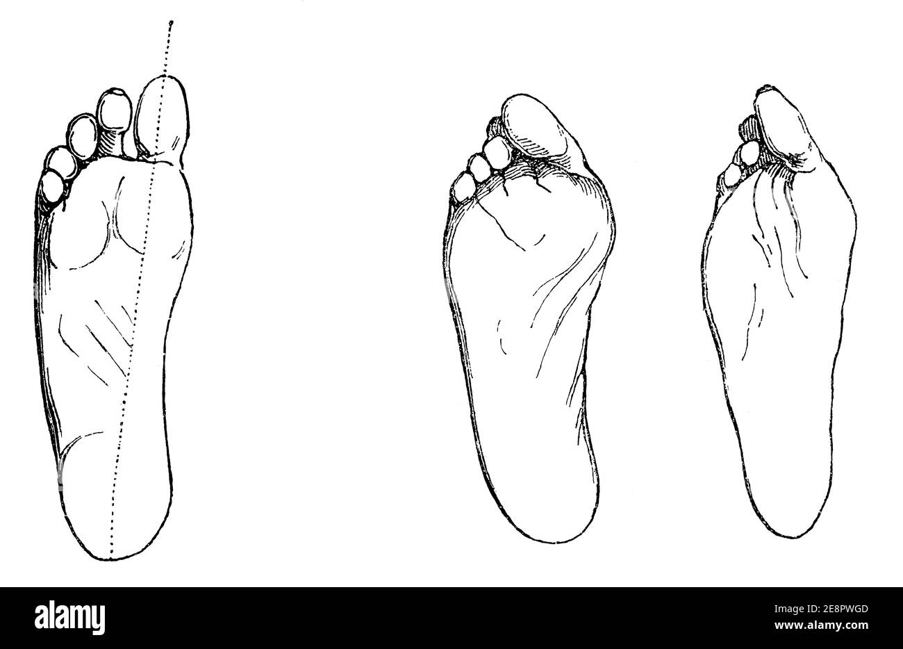 Pie sano (lixiviados) y enfermo (derechos). Paralizamiento del pie causado por el mal calzado. Ilustración del siglo 19. Alemania. Fondo blanco. Foto de stock