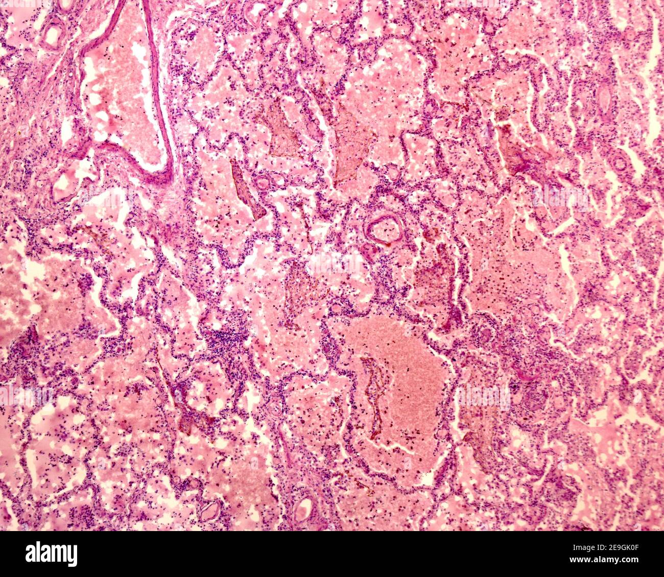 Imagen microscópica de un pulmón con neumonía. Los cordones de células delgadas son los septos alveolares, que delimitan el espacio alveolar, aquí ocupado con leucocitos Foto de stock
