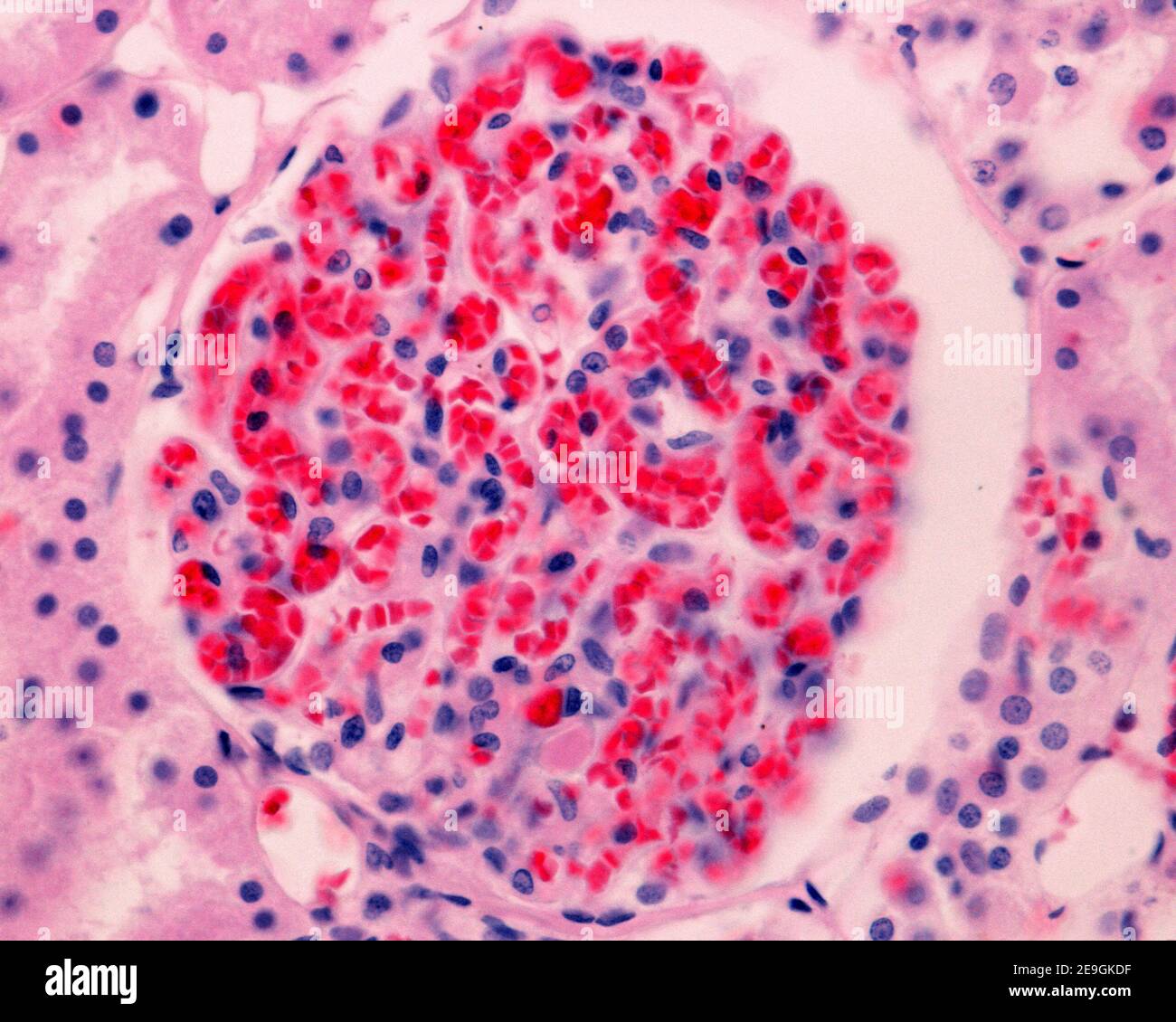 Glomerulus afectado por una congestión capilar grave. Los capilares glomerulares están llenos de glóbulos rojos. Riñón humano. Tinción de H&E. Foto de stock