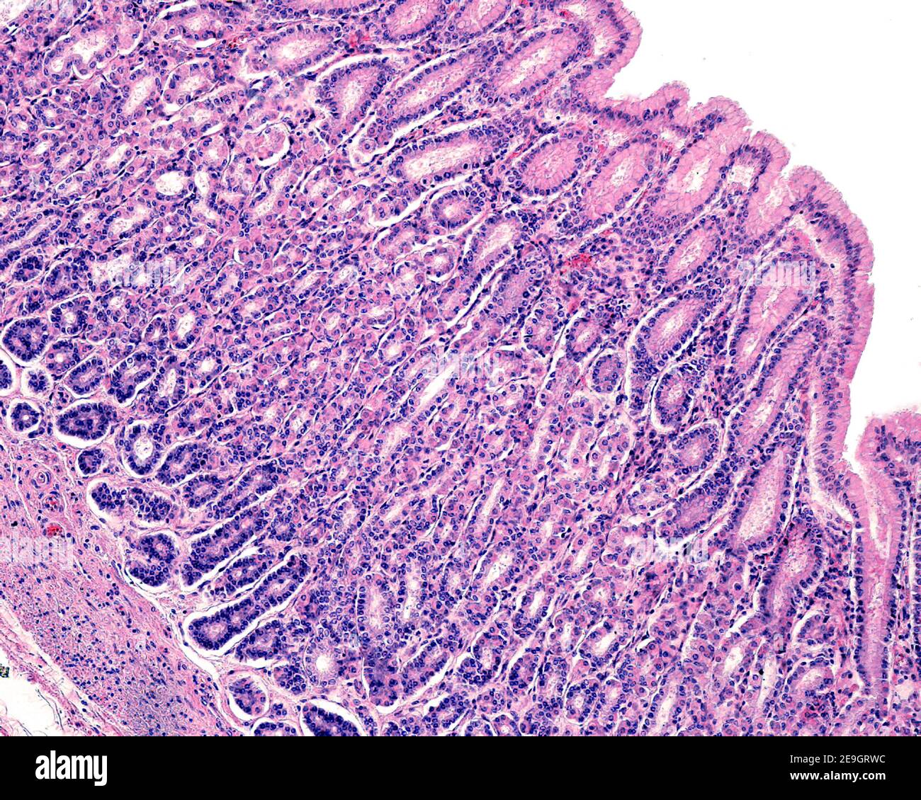 Mucosa de un estómago humano que muestra: Epitelio superficial, fosas gástricas. Las glándulas fundícas se abren en las fosas y tienen células parietales y principales Foto de stock