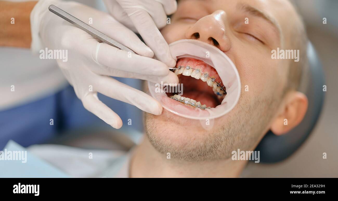 Paciente con ortodoncia dental durante una visita ortodoncia regular Foto de stock