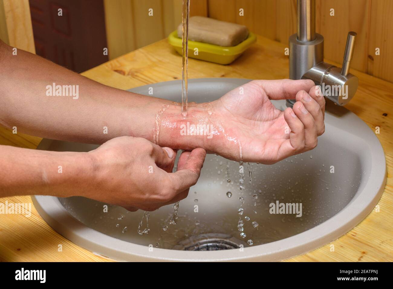 Un hombre lava una abrasión en su brazo bajo correr agua Foto de stock