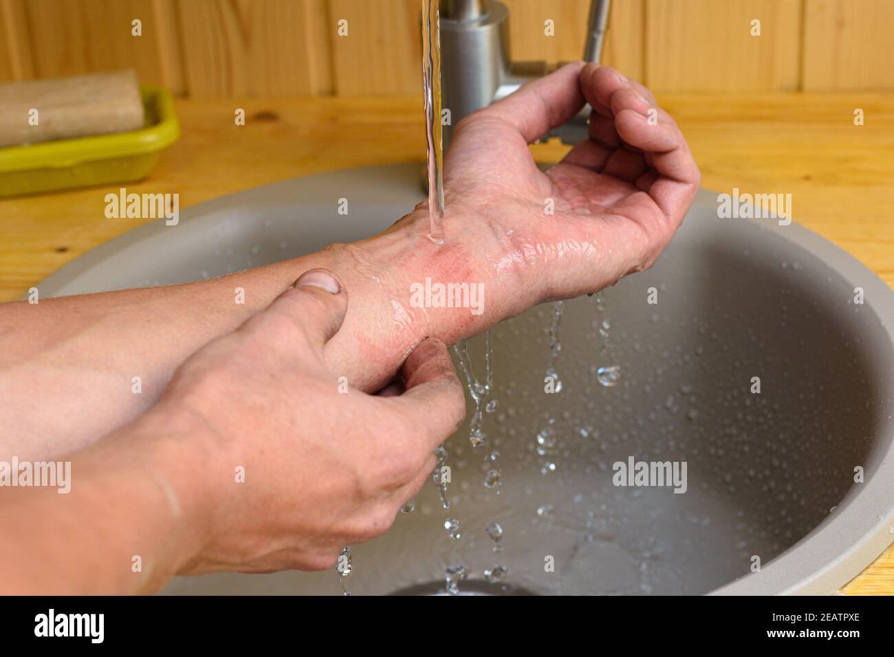 Un hombre lava la herida en su brazo bajo el correr agua en el fregadero Foto de stock