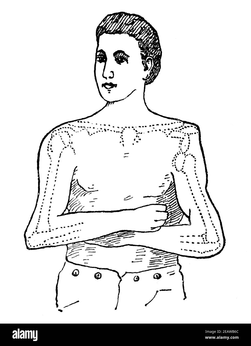 Representación esquemática de la dislocación de la articulación del hombro. Ilustración del siglo 19. Alemania. Fondo blanco. Foto de stock