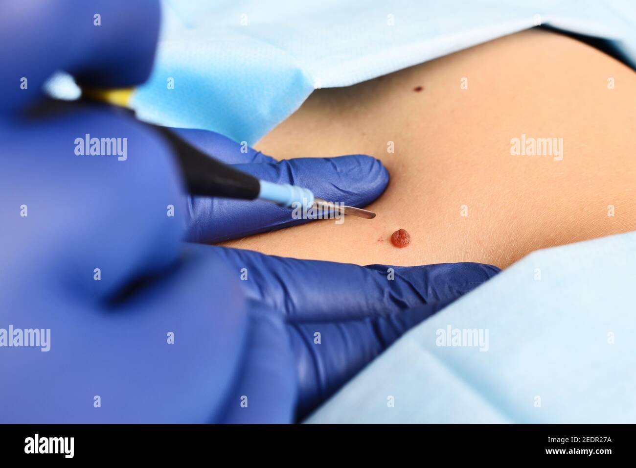Un cirujano dermatólogo extrae una neoplasia - un lunar o nevo del abdomen  del paciente con un cuchillo de ondas de radio. Cirugía estética,  prevención de la mela Fotografía de stock - Alamy