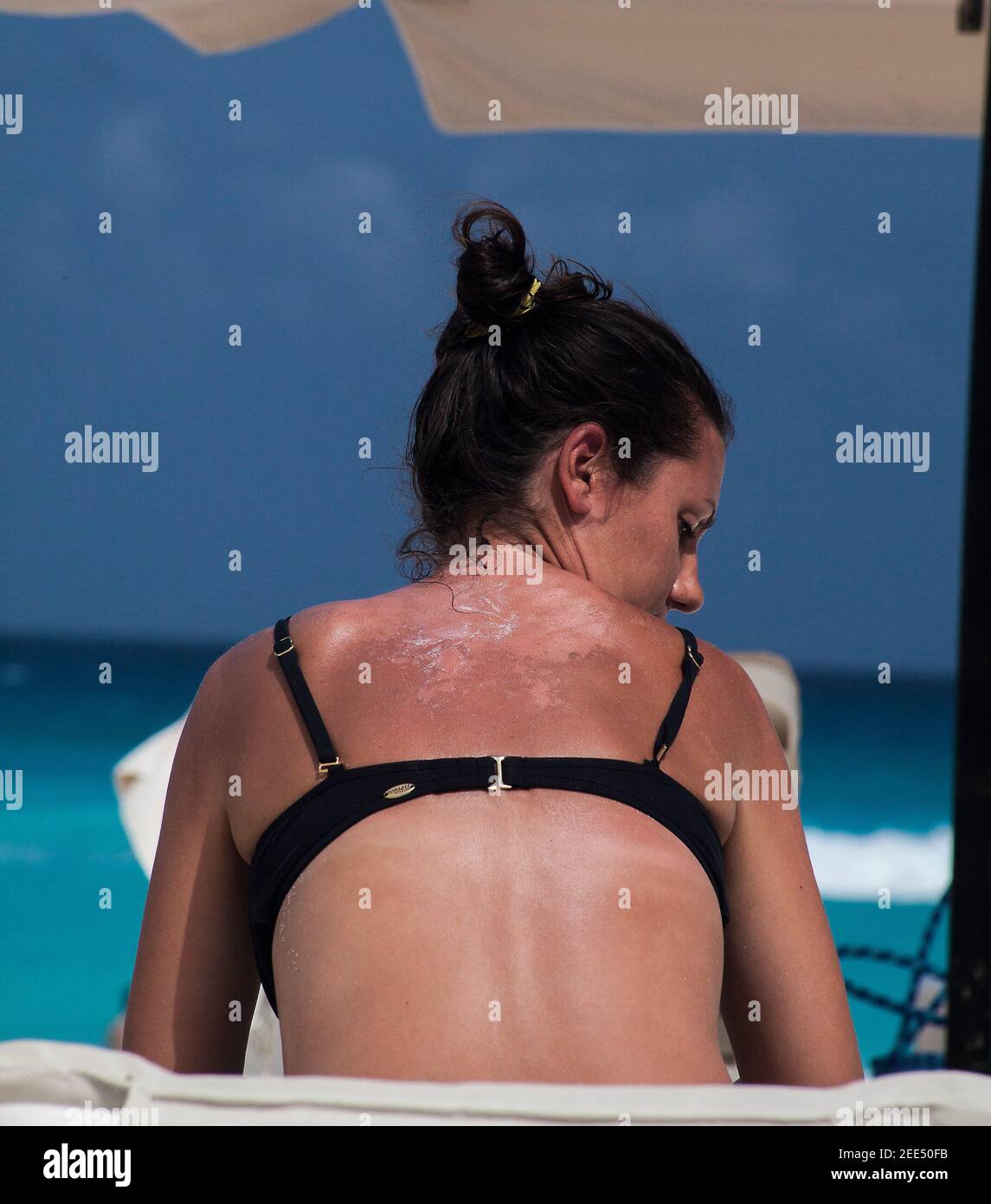 mujer con la espalda quemada por el sol Foto de stock