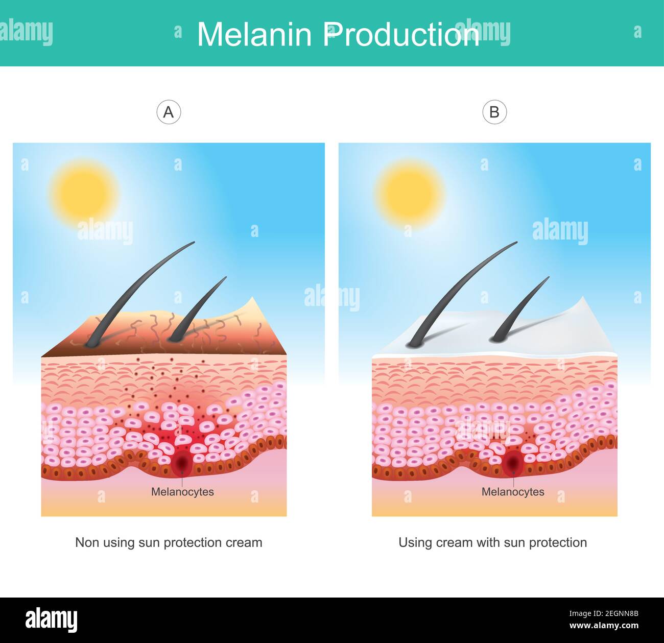 Producción de melanina. Ilustración que muestra el color de la piel humana afectan de los rayos UV la causa de las estimulaciones células melanocitarias en las capas de la piel. Ilustración del Vector