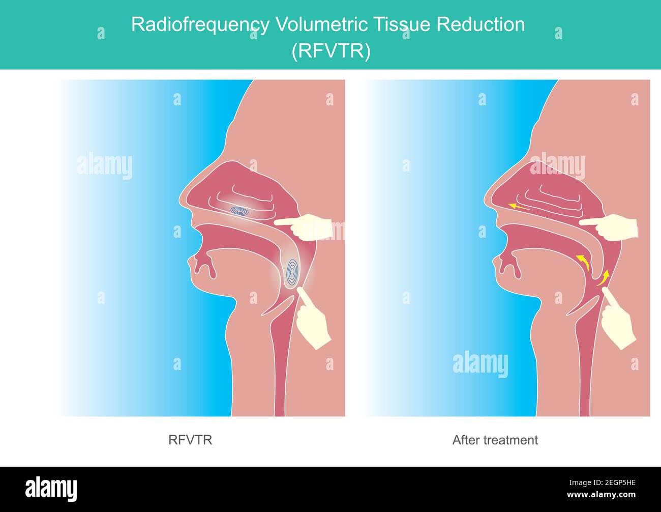 Radiofrecuencia. Reducción volumétrica de tejidos RFVTR. Esta ilustración muestra la tecnología médica para tratar la obstrucción nasal y los síntomas de ronquido por Ilustración del Vector