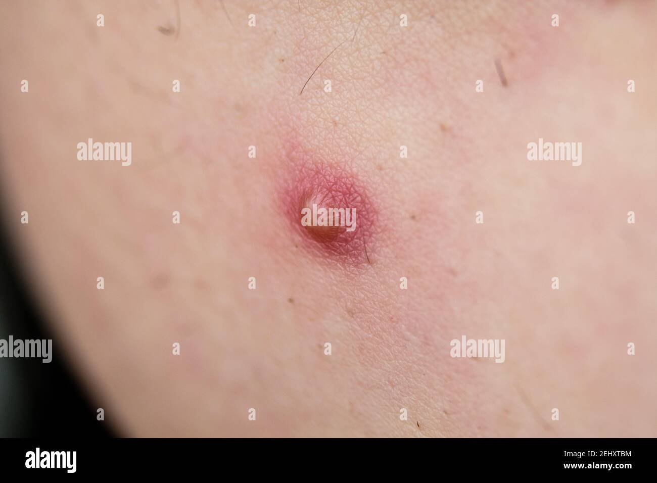 Pimple en la infección de la piel Pímple a estallar Foto de stock