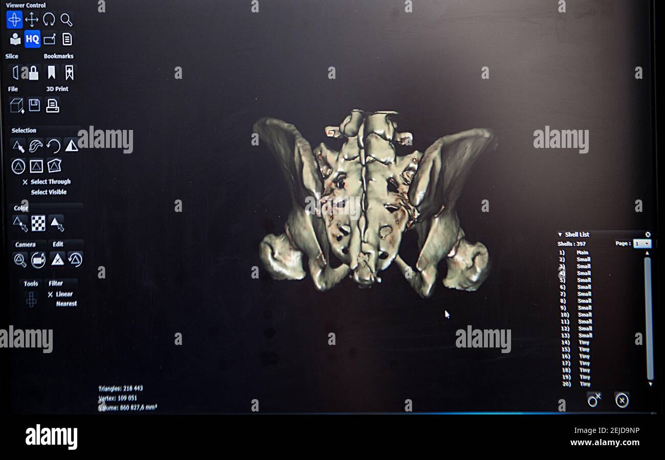 Reconstrucción 3D a partir de una imagen de TC de la pelvis de un paciente para una impresión 3D personalizada. Foto de stock
