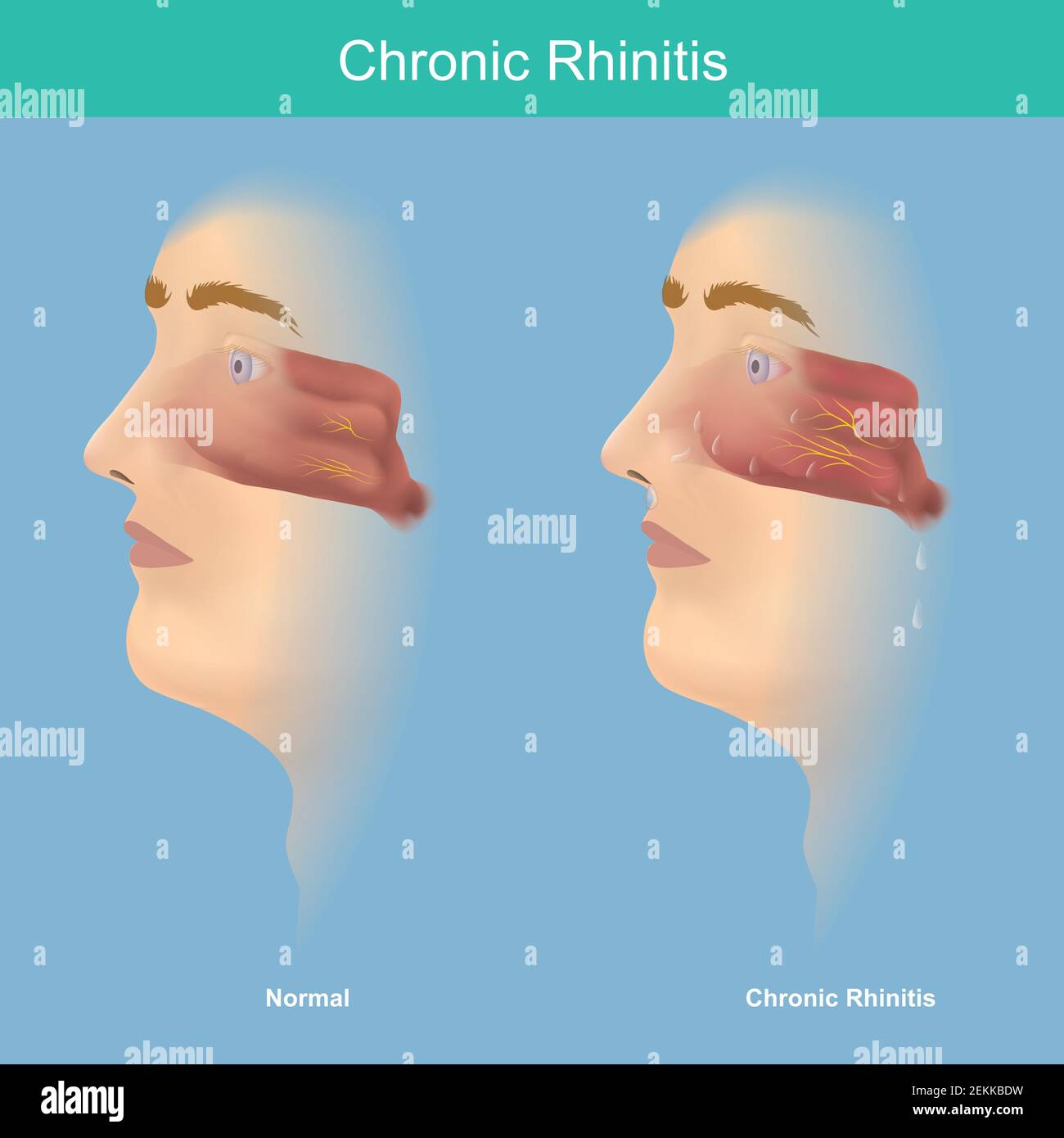 Rinitis crónica. Esta ilustración uso médico para explicar la comparación los síntomas de rinitis crónica tienen moco en la nariz y la garganta. Ilustración del Vector