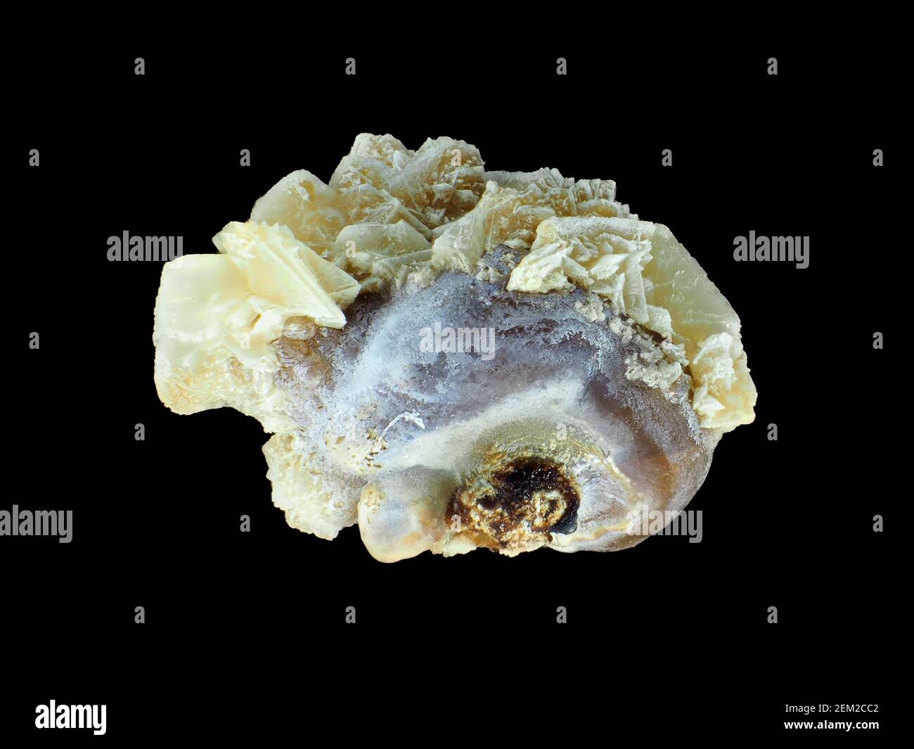 Pequeño cálculo renal humano común (oxalato de calcio), de aproximadamente 3 mm de longitud, bajo el microscopio Foto de stock