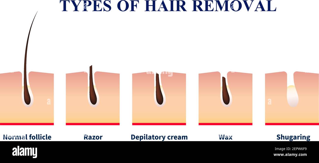 Folículo normal y tipos de depilación con ayuda de la afeitadora, crema de  depilación, cera, azúcar vector ilustración Imagen Vector de stock - Alamy