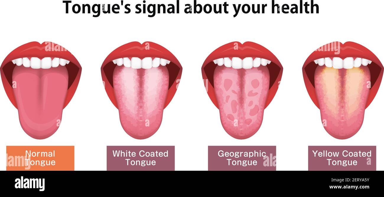 Ilustración del vector de signos de salud de la lengua ( Lengua con  revestimiento blanco Imagen Vector de stock - Alamy