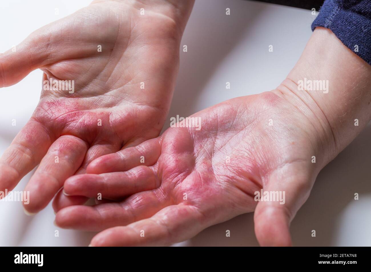 Dermatitis atópica, roja, picazón en las manos con ampollas y piel  agrietada Fotografía de stock - Alamy