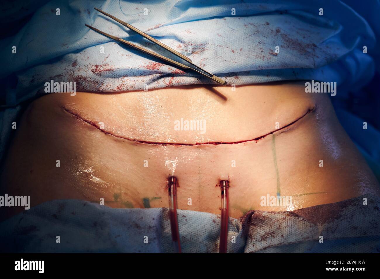 Abdominoplastía (Cirugía Estética del Abdomen) - Kelamis Plastic