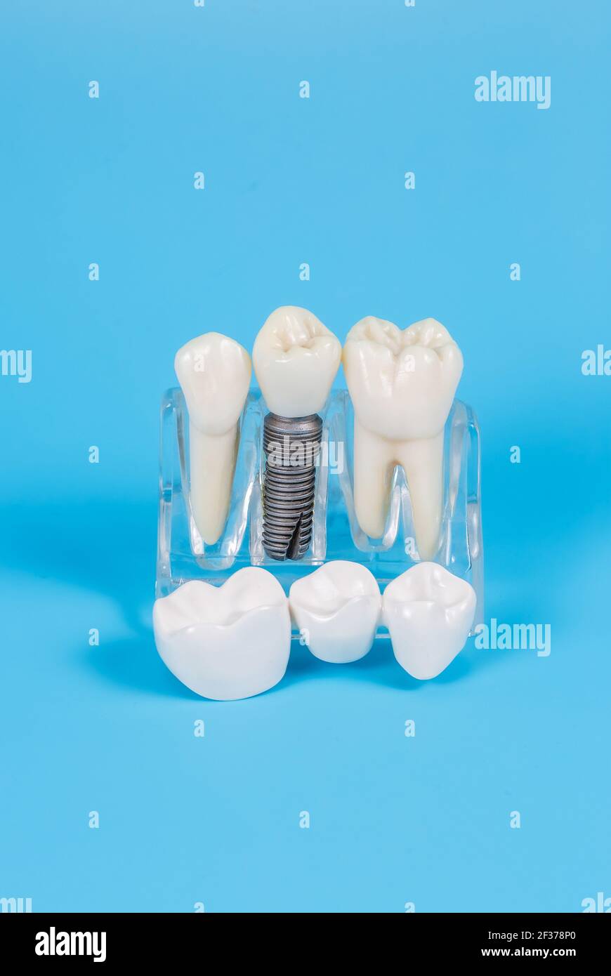 Coronas dentales de plástico, imitación de una prótesis dental de un