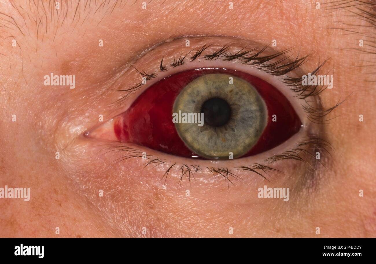 Vaso sanguíneo roto fotografías e imágenes de alta resolución - Alamy