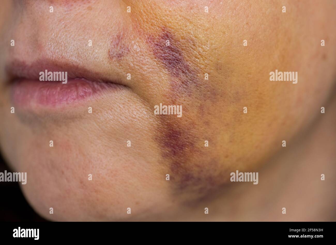 Mujer irreconocible con moretones en la cara Fotografía de stock - Alamy