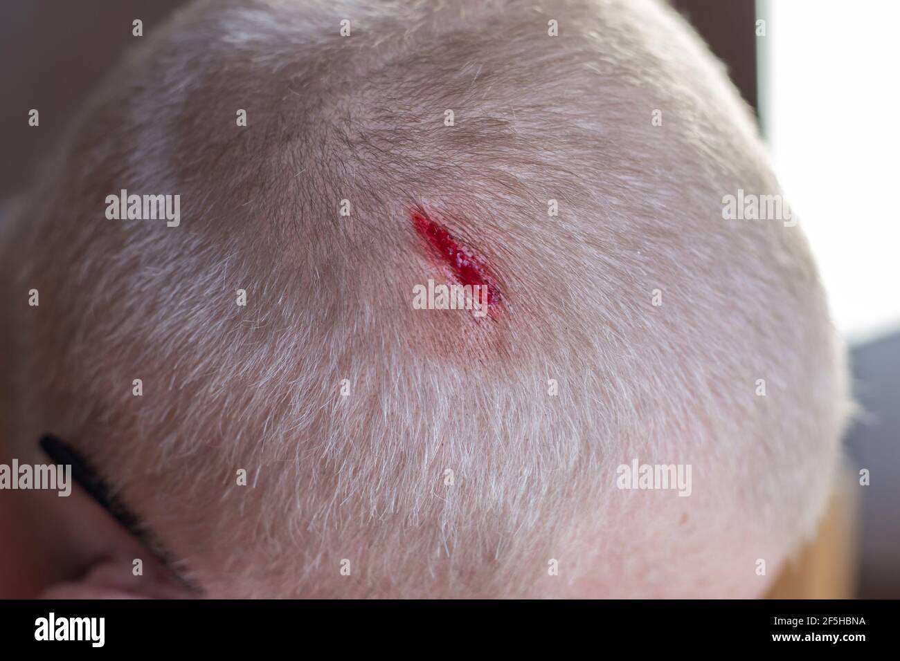 Lesión en el cuero cabelludo. La sangre se escapa de una herida picada en  la cabeza. La enfermera trata la herida con peróxido de hidrógeno. Primeros  auxilios Fotografía de stock - Alamy