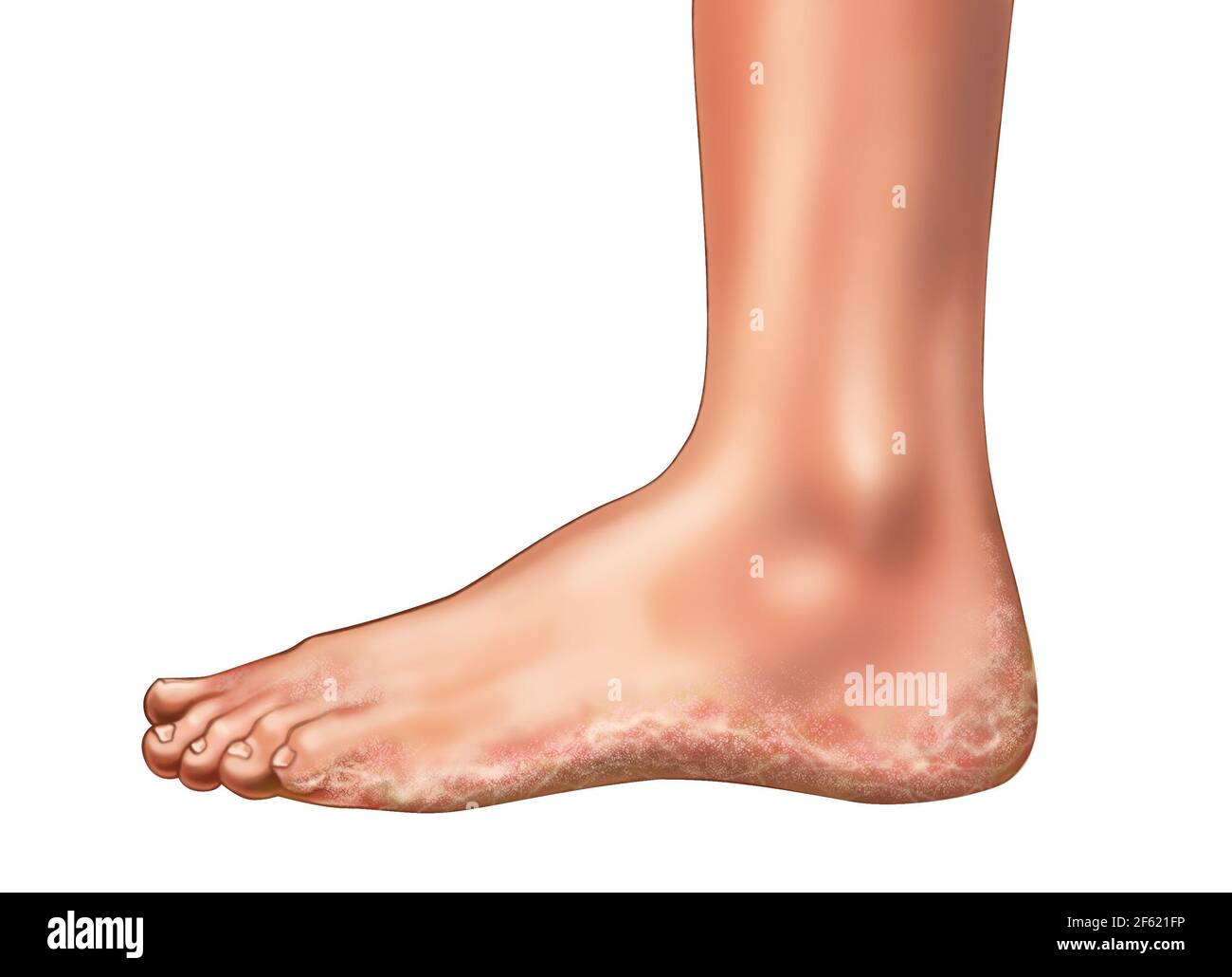 Hongo de pie de atleta fotografías e imágenes de alta resolución Alamy