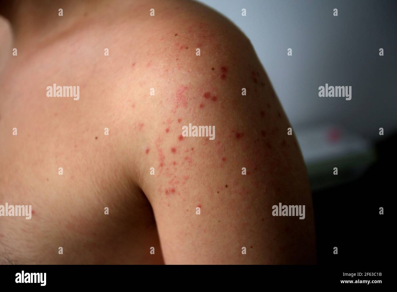 Roseola Virus Fotos E Imagenes De Stock Alamy