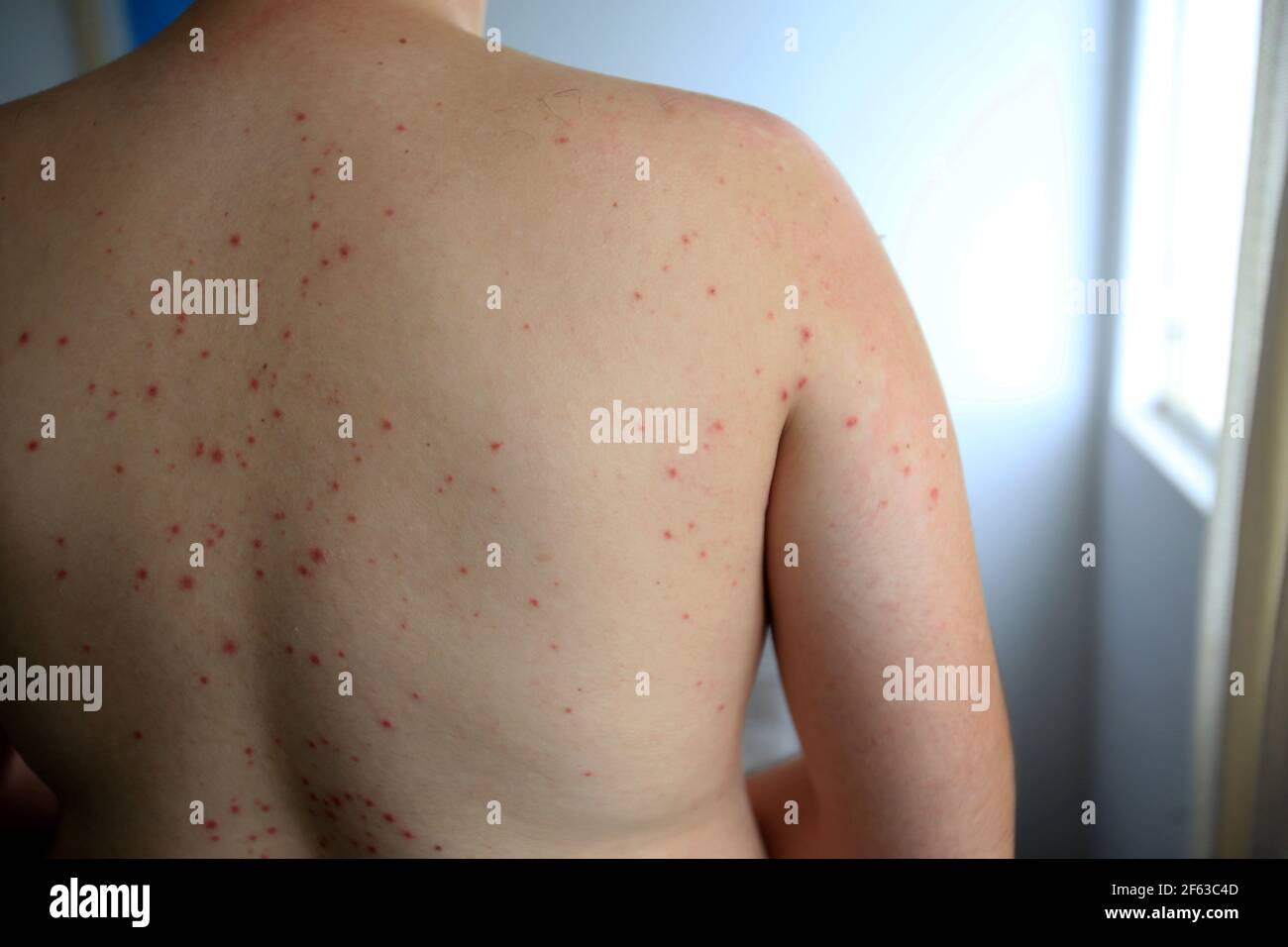 Roseola Virus Fotos E Imagenes De Stock Alamy