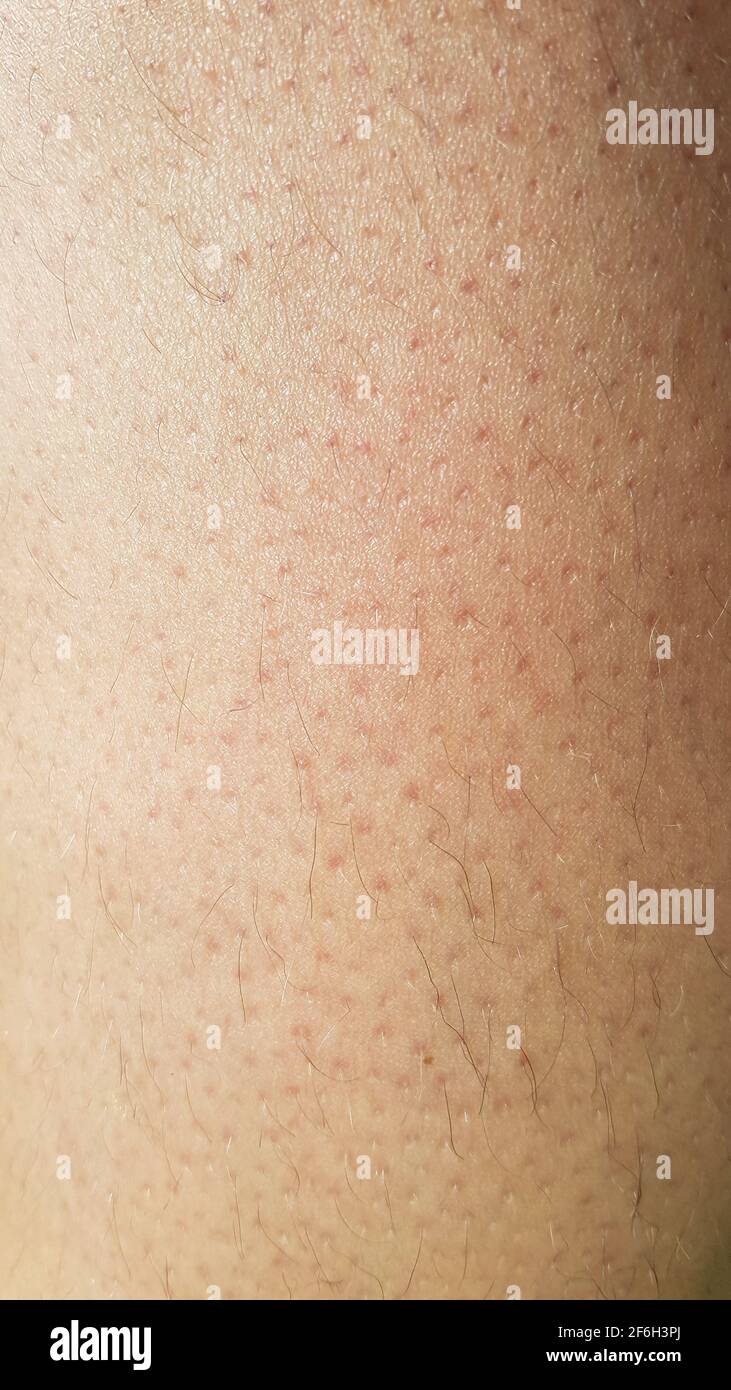 Primeros planos de la piel macro poros del cabello enrojecimiento dermia  dermatológica macro de la piel irritación puntos de cuidado pelos células  estructura de papel Fotografía de stock - Alamy