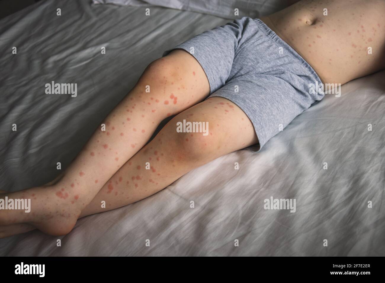 Roseola Fotos E Imagenes De Stock Alamy Roseola Fotos E Imagenes De Stock Alamy