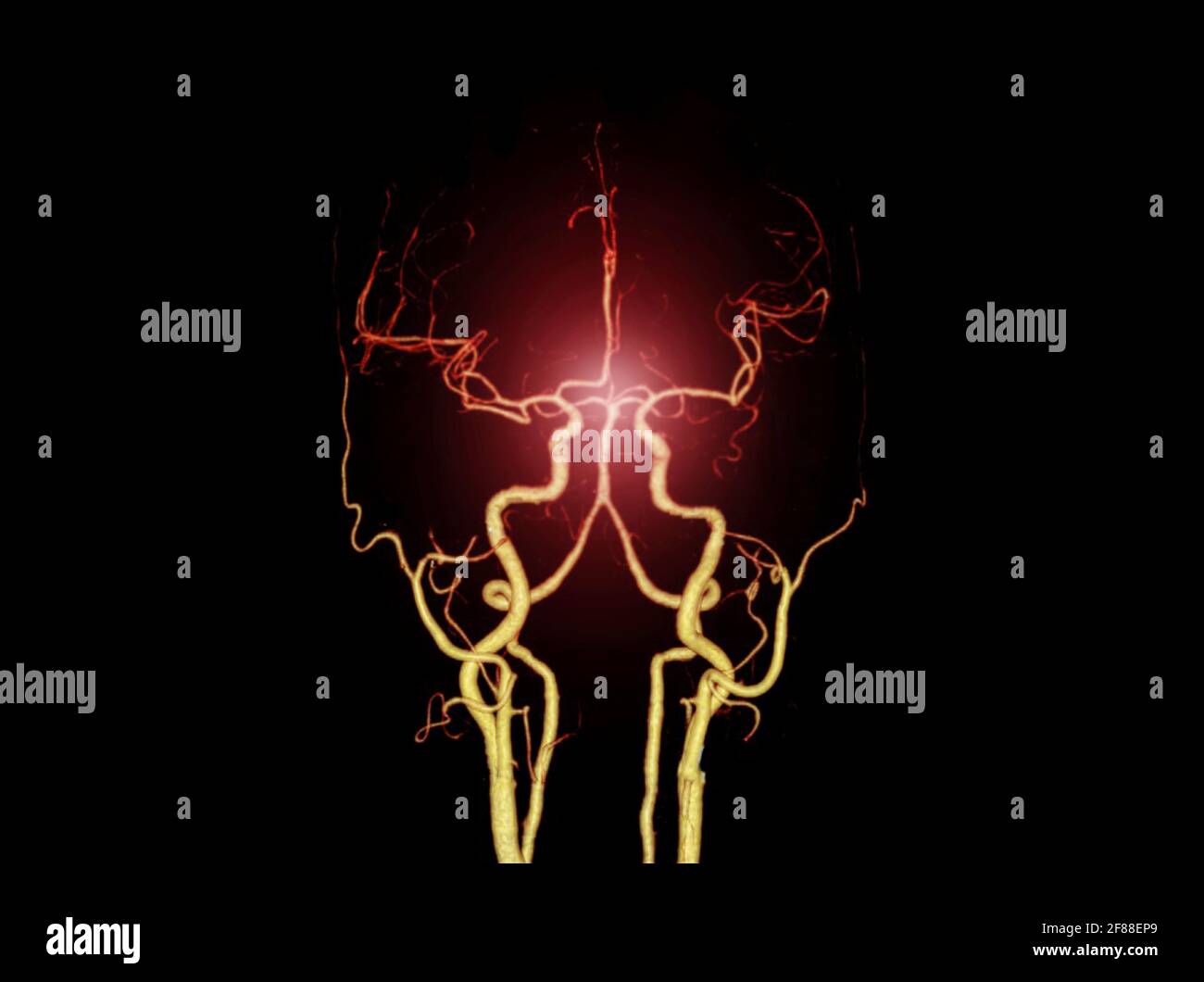 Angiografía cerebral fotografías e imágenes de alta resolución - Alamy