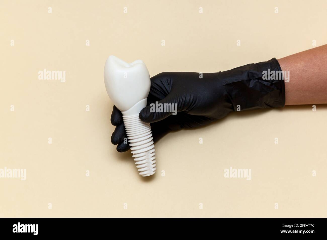 La mano femenina en un guante médico negro sostiene un implante dental sobre un fondo beige. Modelo de implante dental de diente artificial. Concepto de odontología y. Foto de stock