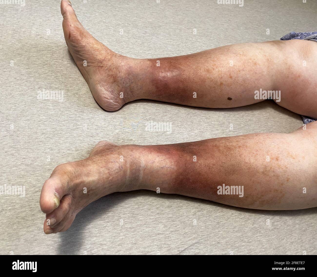 Las piernas de una mujer se muestran, ella está sufriendo de insuficiencia venosa crónica con celulitis leve en sus piernas. En cama mientras descansa para aliviar la pesadez Foto de stock